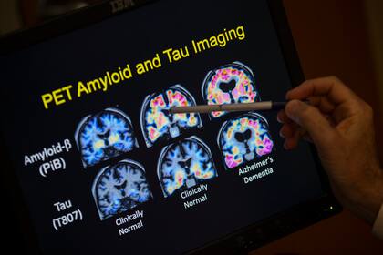 La mayor parte de las investigaciones sobre el Alzheimer se enfocaron en dos proteínas, conocidas como amiloide y tau, que se acumulan en el cerebro de las personas con la enfermedad
