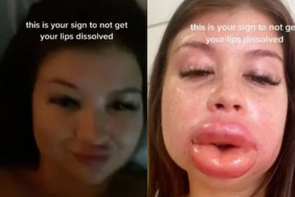 La modelo mostró el resultado de la intervención estética en su cuenta de TikTok (Captura @KarliGardner)