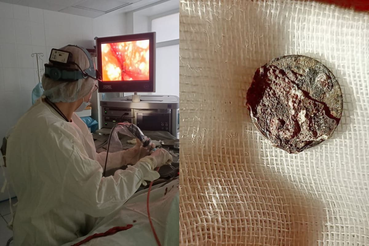 La moneda de un kópek se conservó por 53 años en la nariz del paciente (Departamento de Salud de Moscú)