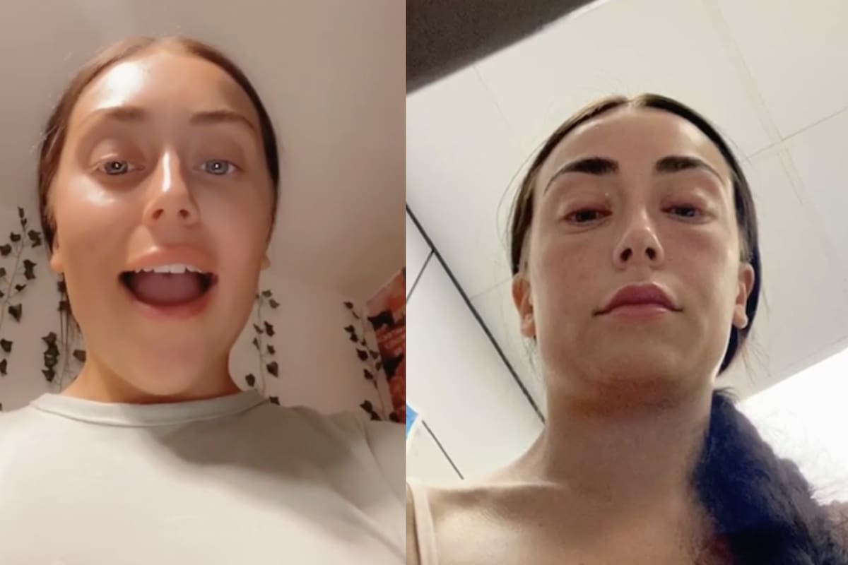 La mujer mostró cómo se le hincharon los ojos tras el tratamiento