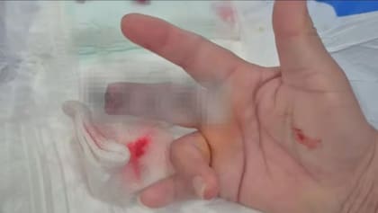 La mujer perdió parte de su dedo en el ataque