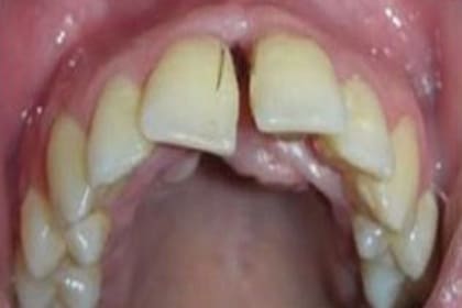 La mujer presenta uno de los pocos casos en el mundo de hirsutismo gingival