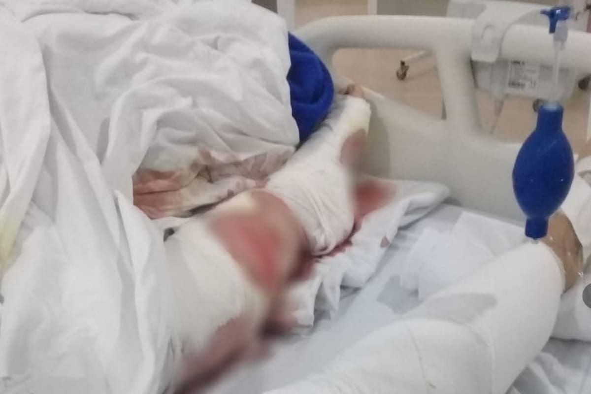 La mujer recibió 25 mordeduras en sus piernas