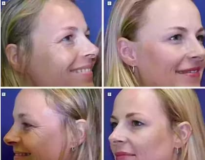La mujer ubicada a la derecha recibía inyecciones regulares de Botox (Foto: Gentileza Asociación Médica Estadounidense)