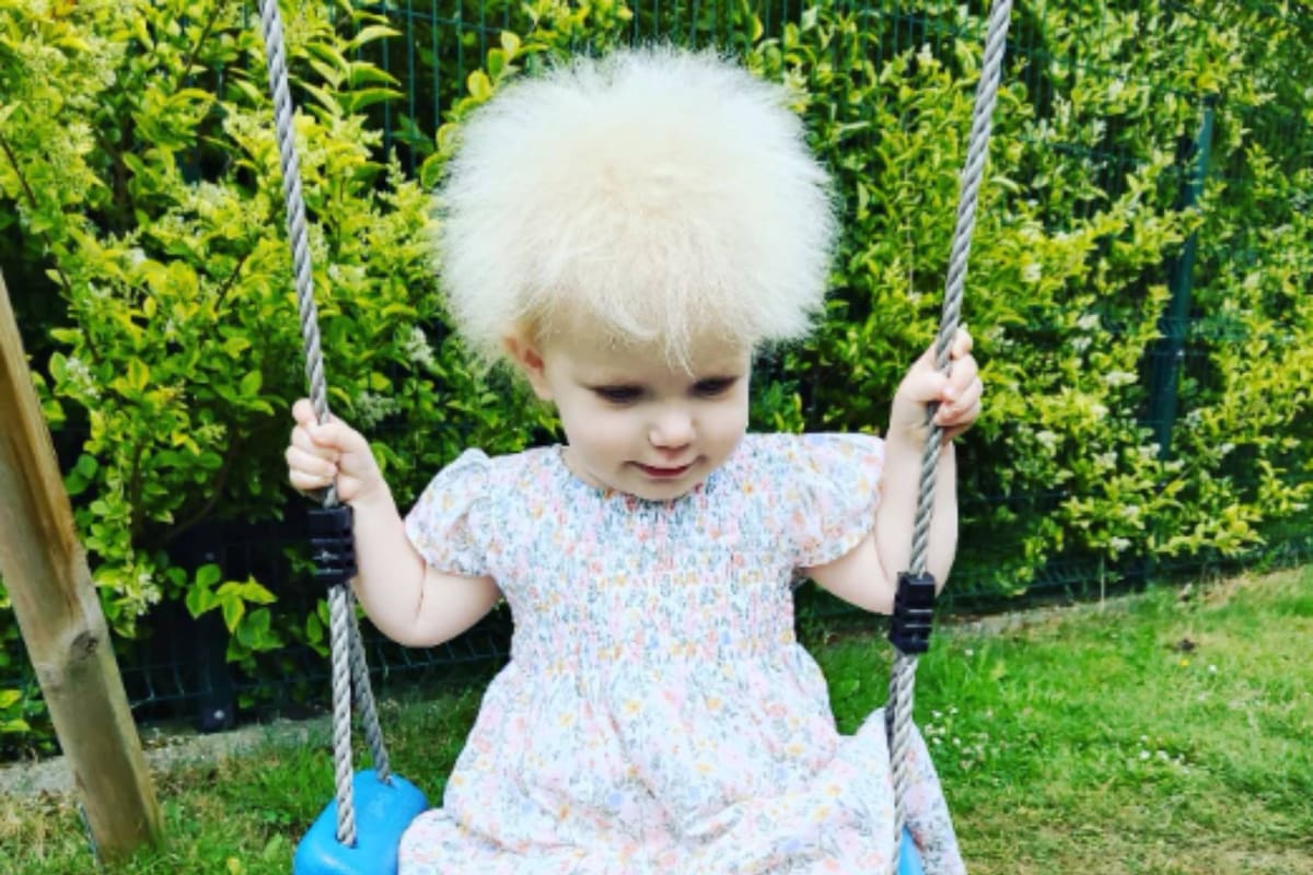 La niña posee el síndrome del cabello incontrolable