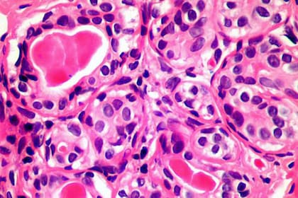 La nueva técnica podría atacar una amplia gama de células cancerosas, incluidas las de mama y próstata