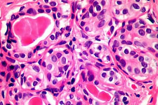 Un análisis de sangre experimental podría alertar del cáncer cuatro años antes