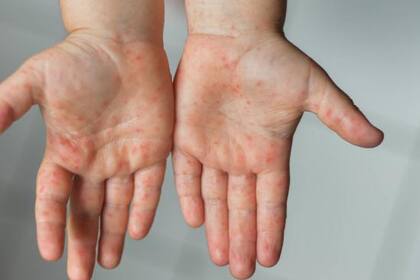 La OMS alertó sobre el avance de la enfermedad en el mundo