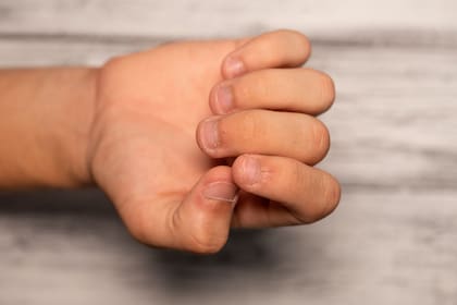 La onicofagia sostenida en el tiempo puede generar daños progresivos en las uñas y la piel circundante