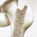 La enfermedad que puede avanzar sin dolor y se descubre después de que ocurra una fractura