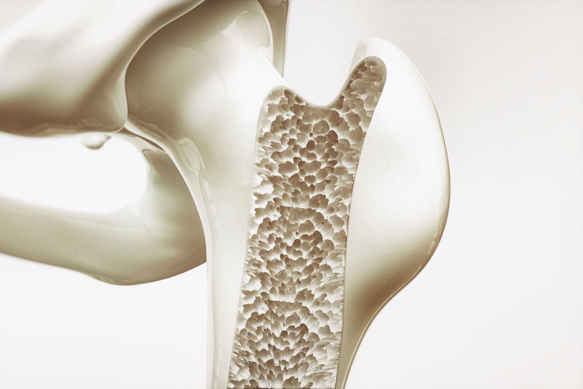 La osteoporosis puede avanzar durante meses o incluso años sin provocar señales claras de alerta