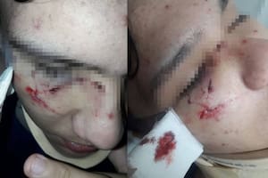 La patota le dio puntazos en la cara y le fisuró la nariz