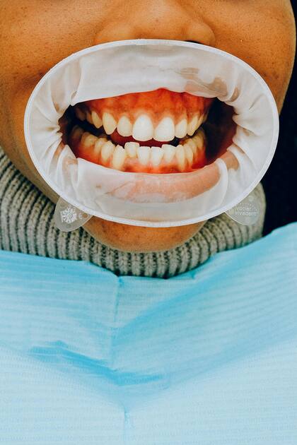 La pérdida temprana de dientes de leche, por ejemplo, puede alterar el espacio necesario para la correcta erupción de los dientes permanentes