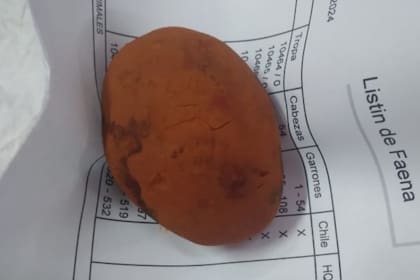 La piedra biliar encontrada al empleado