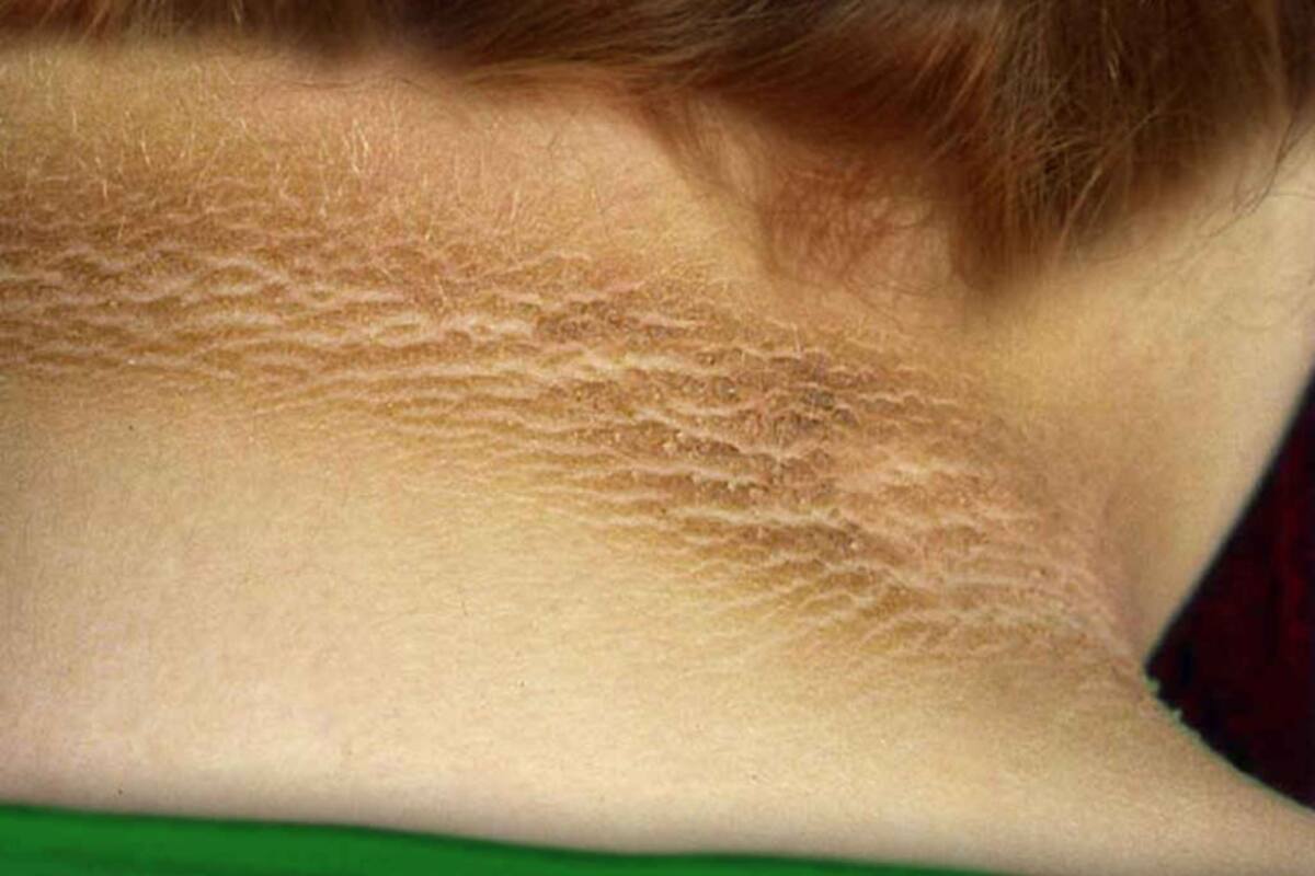 La piel engrosada, más oscura y aterciopelada que se muestra aquí, conocida como acantosis nigricans, es un posible signo de advertencia del desarrollo de diabetes tipo 2