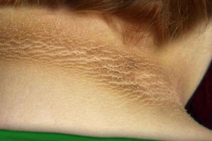 La piel engrosada, más oscura y aterciopelada que se muestra aquí, conocida como acantosis nigricans, es un posible signo de advertencia del desarrollo de diabetes tipo 2