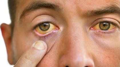 La piel y los ojos amarillos son signos de un hígado dañado