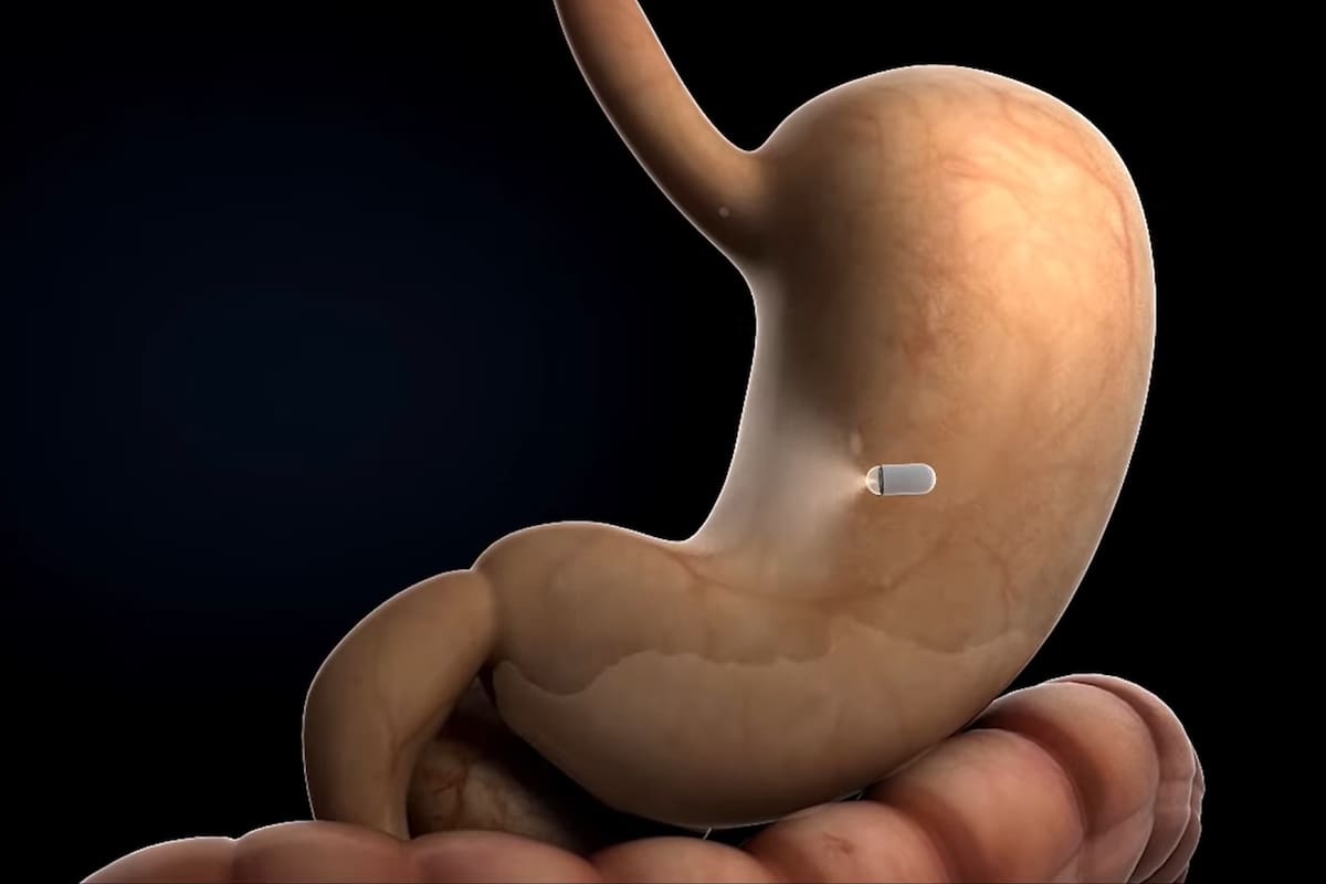 La píldora desarrollada por Anx Robotica y la universidad George Washington permite hacer una endoscopía sin el tubo flexible; se mueve por el interior del cuerpo controlada en forma remota por el médico