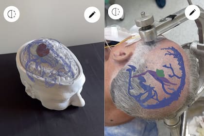 La plataforma de realidad aumentada Visionary permite mostrar con gran precisión la anatomía interna del paciente antes y durante una cirugía, usando un celular o anteojos de realidad virtual