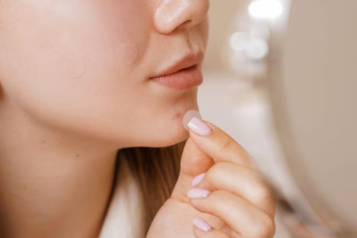 La principal función de los parches de acné es retirar la pus de un grano infectado, para desinflamarlo y hacer que desaparezca en menos tiempo del convencional