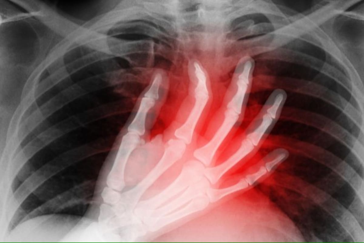 La PRN es una técnica de trasplante que ha permitido aumentar la cantidad de órganos que se pueden utilizar exitosamente