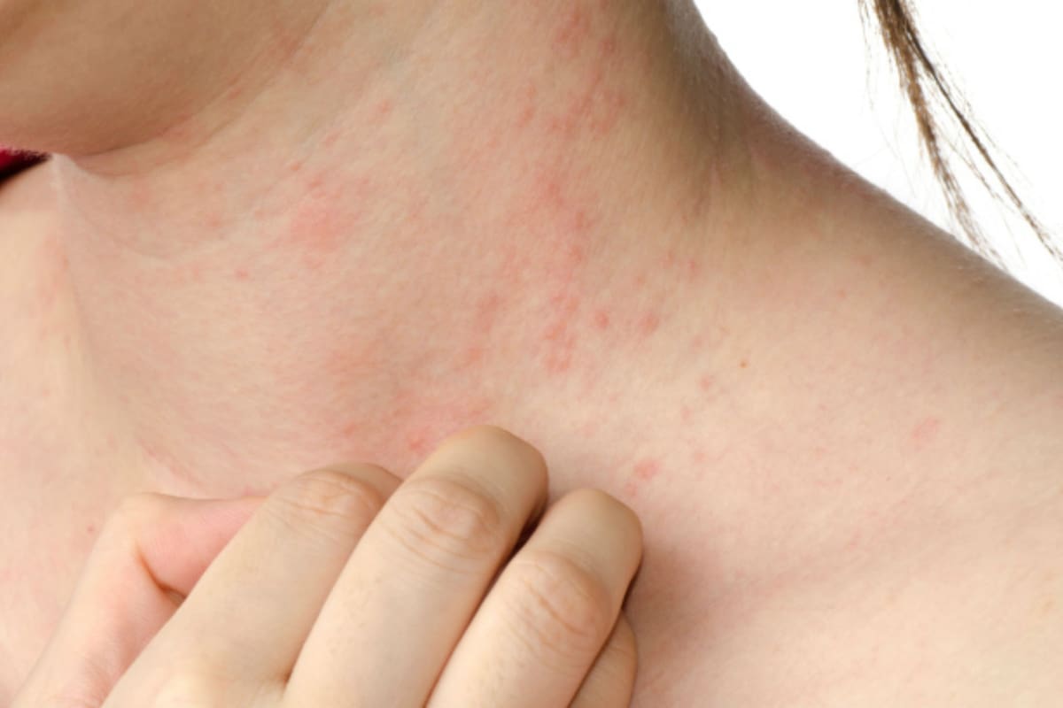 La psoriasis es una enfermedad muy incómoda