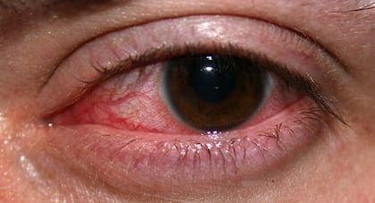 La queratitis por acanthamoeba afecta a las personas que utilizan lentes de contacto bajo el agua (imagen ilustrativa)