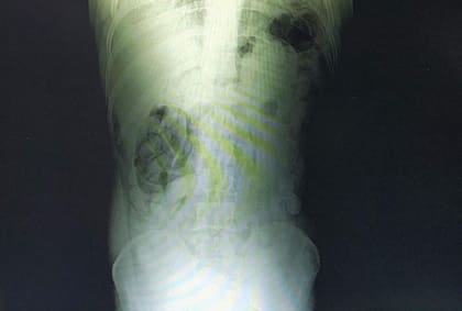 La radiografía de uno de los individuos que denota la presencia de las cápsulas
Foto: Ministerio de Seguridad Nacional