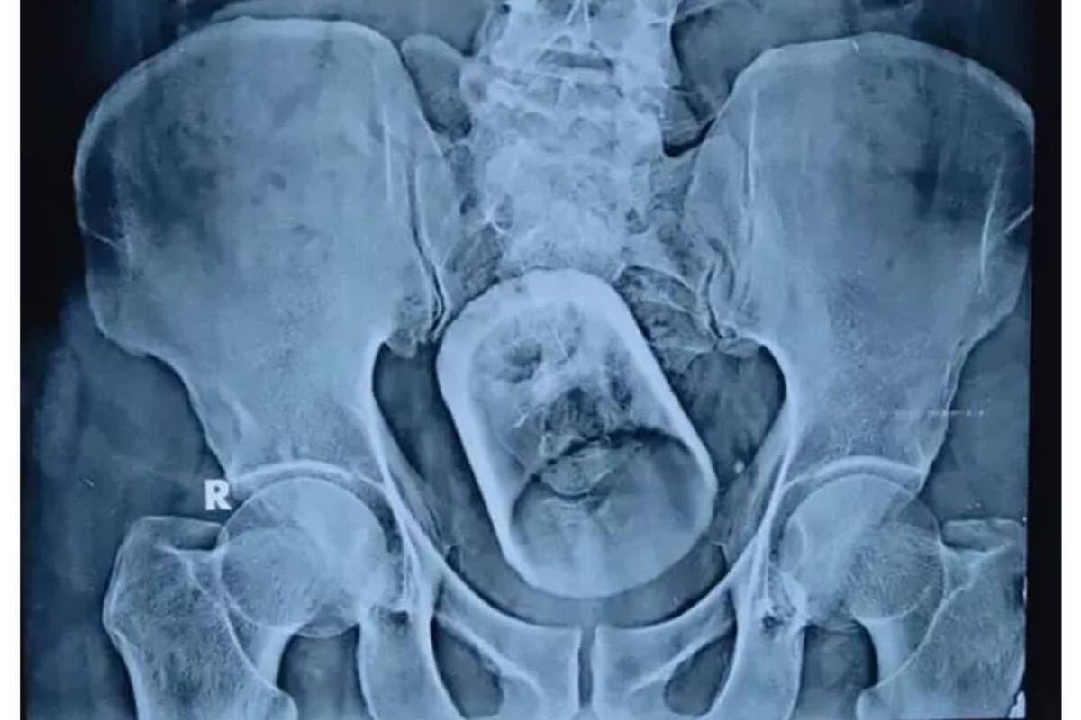 La radiografía del hombre de 55 años