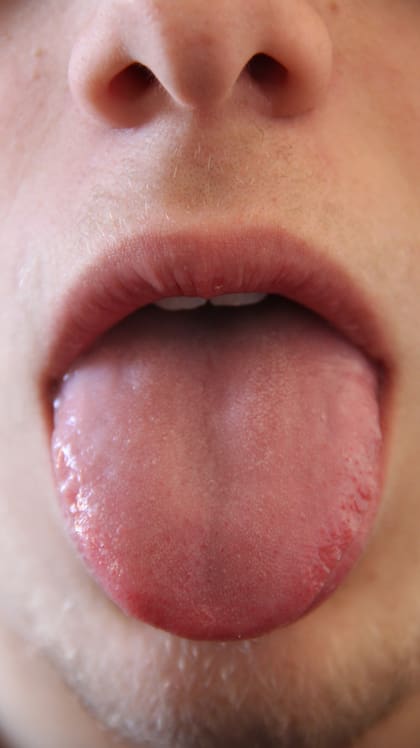 La razón más preocupante por tener la lengua blanca es el hongo Candida albicans, que a a larga puede generar más problemas