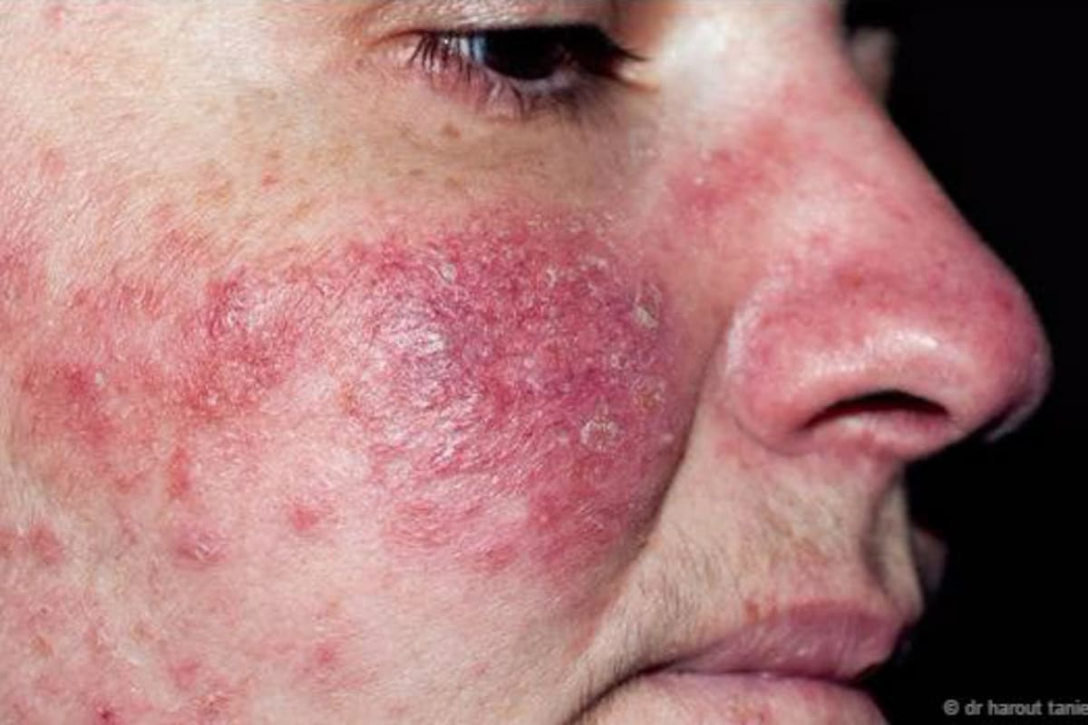 La rosácea puede producir marcas muy pronunciadas