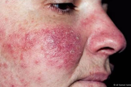 La rosácea puede producir marcas muy pronunciadas