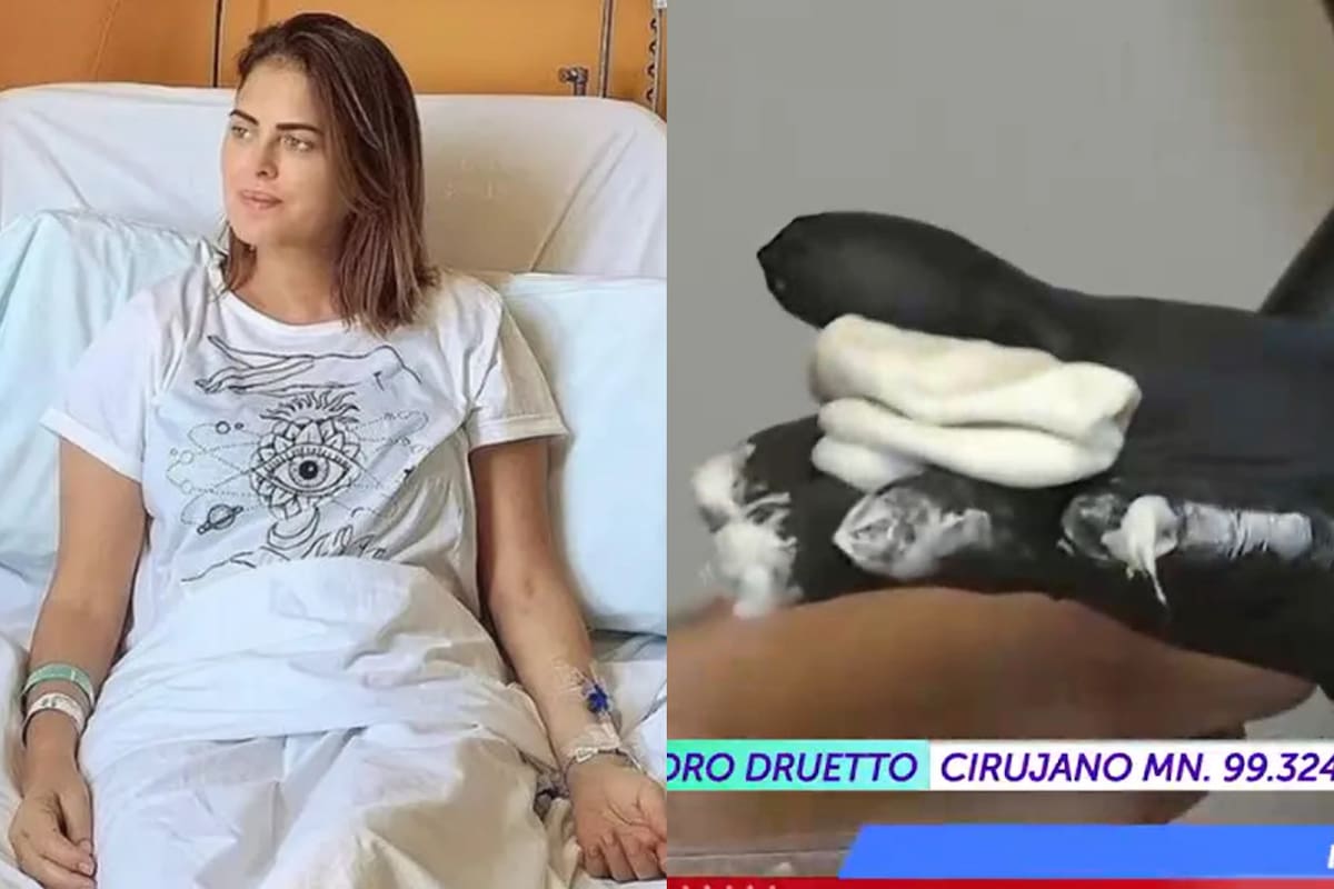 La salud de Silvina Luna: un médico cirujano preparó el metacrilato en vivo y mostró cómo se endurece dentro del cuerpo