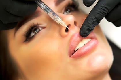 La sensación de repetición de facciones entre personas es producido por una misma receta en la aplicación de rellenos, señalan los esteticistas consultados