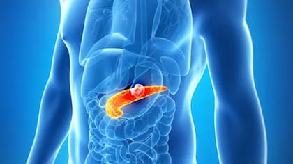 La supervivencia a los cinco años del diagnóstico de cáncer de páncreas apenas supera el 10%
