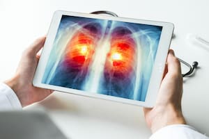 Premio por una tecnología que puede ayudar a combatir el cáncer de pulmón