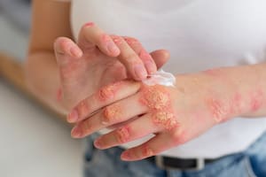La tiña es una infección fúngica frecuente que puede afectar tanto la piel como las mucosas