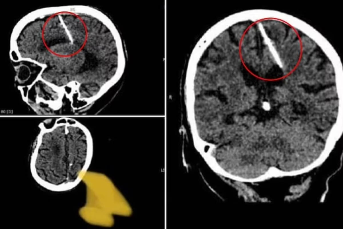 La tomografía computarizada de una mujer de 80 años reveló que la paciente llevaba una aguja en su cerebro y el motivo de ese hecho aterró a todos