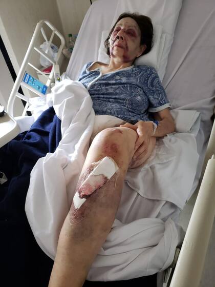 Lidia del Carmen Mendoza, con múltiples fracturas en el rostro, internada en el hospital Italiano