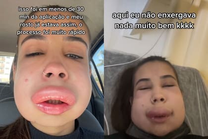 La transformación en el rostro de una influencer brasilera tras someterse a una cirugía
Foto: TIKTOK / @isispolivx