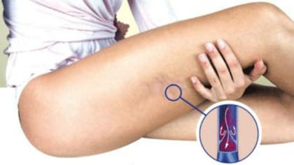 La trombosis es la formación de un coágulo en una vena o arteria que obstruye la circulación de la sangre