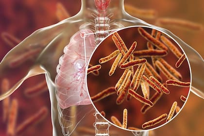 La tuberculosis es causada por la Mycobacterium tuberculosis o bacilo de Koch