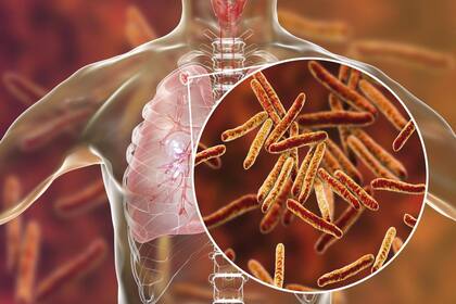 La tuberculosis está causada por el bacilo Mycobacterium tuberculosis y suele afectar a los pulmones