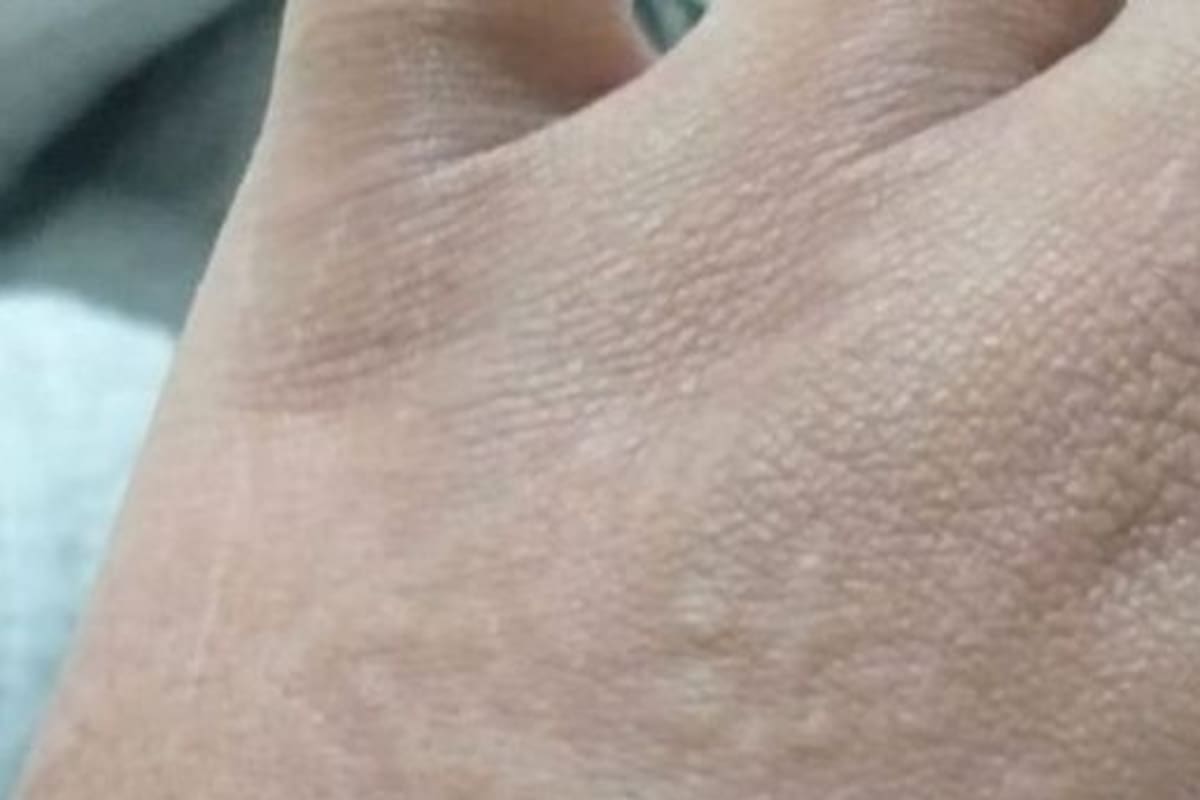 La urticaria es una de las patologías cutáneas asociadas al Covid-19