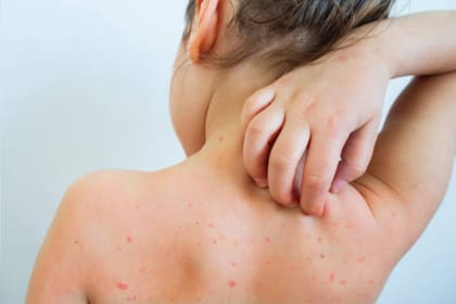 La vacuna no siempre es 100% efectiva, por lo que algunos tendrán una infección “irruptiva” a pesar de estar vacunados, pero estas suelen ser muy leves (Foto Pexels)