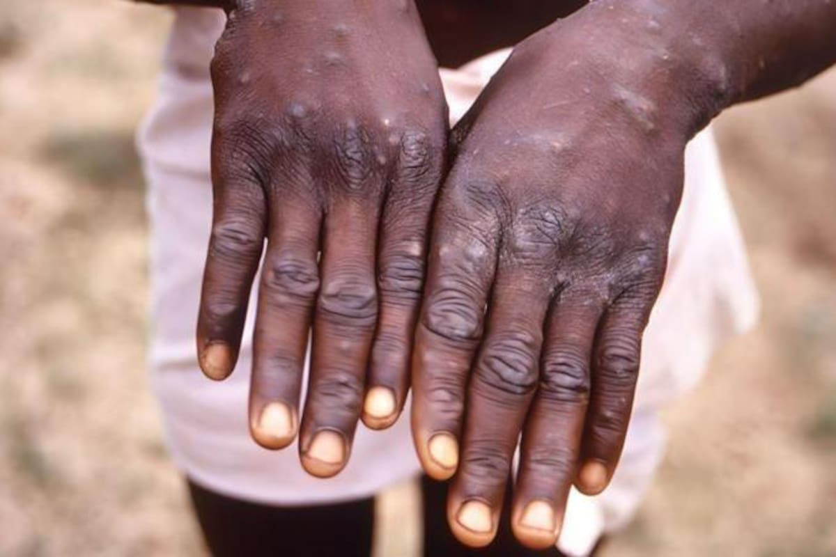 La viruela del mono se transmite por contacto físico con personas infectadas.