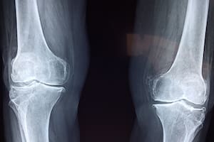 La vitamina D no es la única que ayuda en el cuidado de los huesos