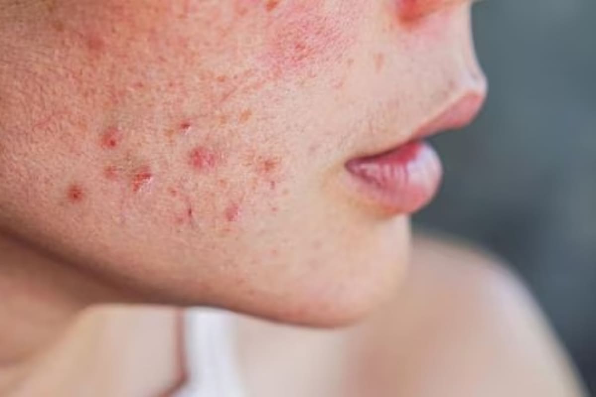 Labios agrietados, piel que se pela, hemorragias nasales: el fármaco trata el acné, pero sus efectos secundarios pueden ser miserables