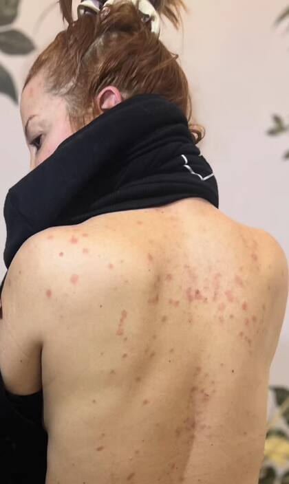 Lanzoni mostró a sus seguidores las marcas de la psoriasis en su cuerpo