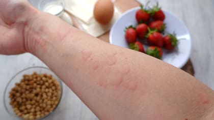 Las alergias alimentarias son de las más comunes